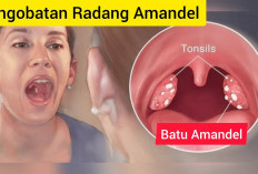 7 Obat Paling Efektif untuk Amandel Bengkak di Apotek