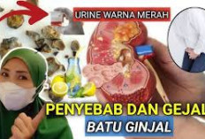 Penyebab Batu Ginjal yang Harus Diperhatikan